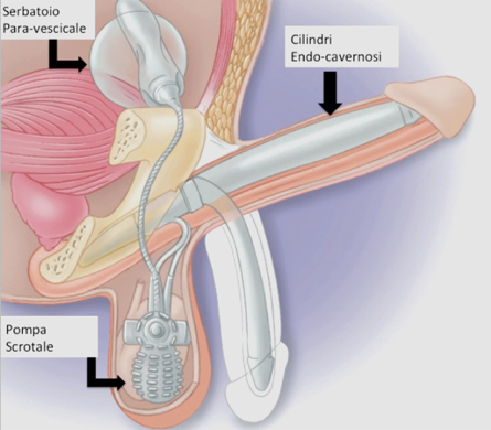 roblog_protesi-tricomponente